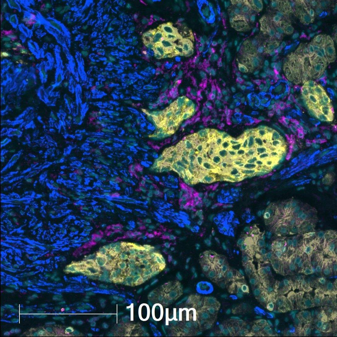 Tumor antigenicity